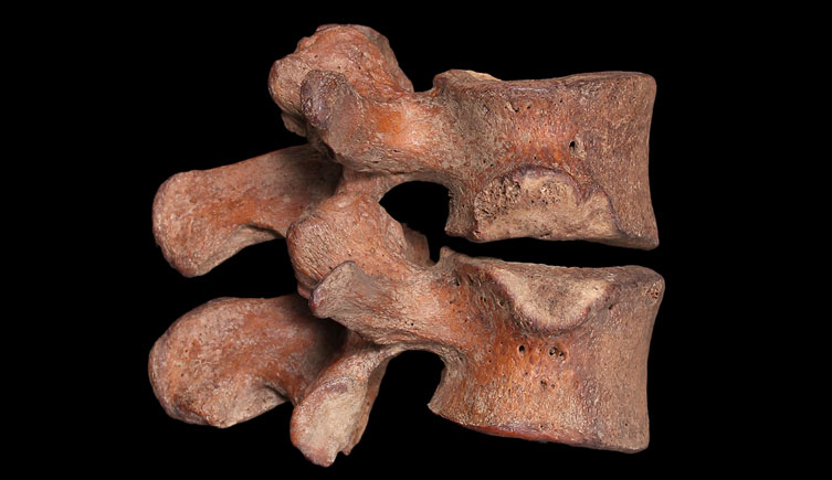 Congenital changes to lumbar vertebrae of prehistoric male individual