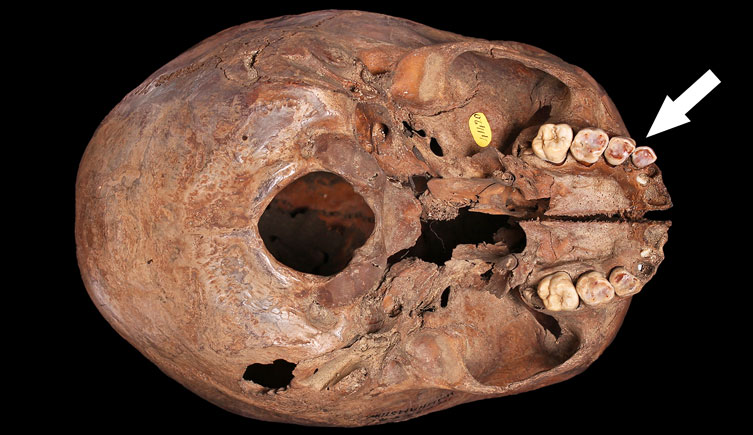 Skull of subadult with dental enamel attrition excavated from Walthamstow Reservoir