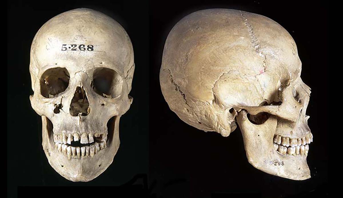 A Homo sapiens skull seen from the front and the side.