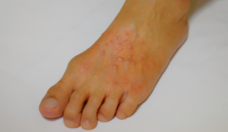 A foot covered in red stings from a red imported fire ant.