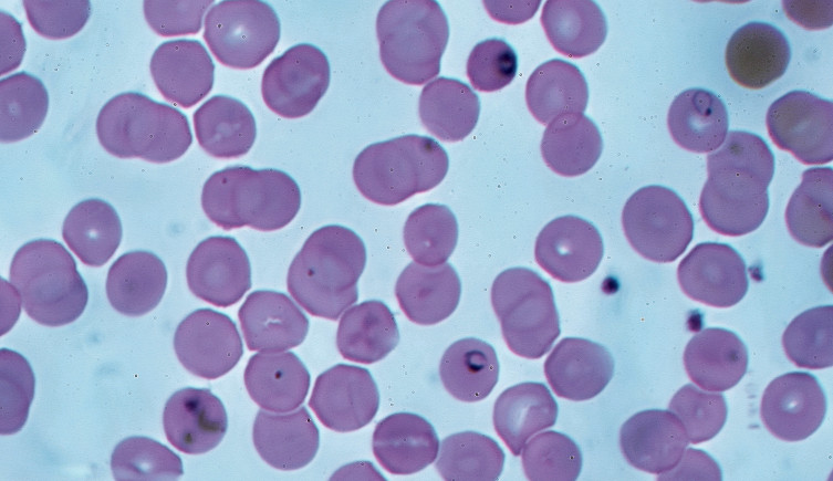 Plasmodium falciparum under a microscope