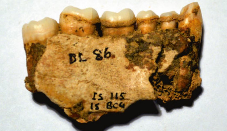 A patch of dental calculus covers a fragment of human jaw containing teeth.