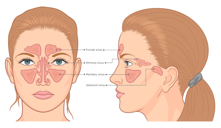 A diagram of a human face with the sinuses labelled