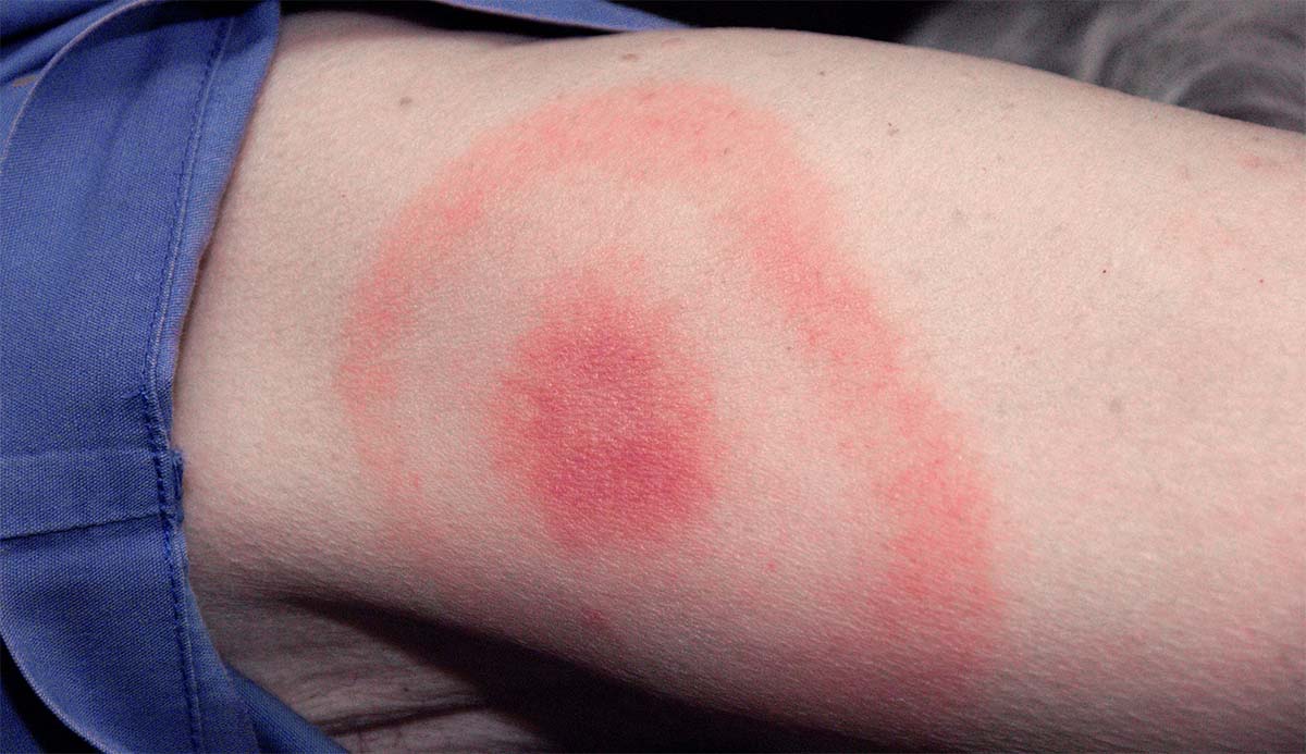 A red target-shaped rash caused by Lyme disease on a human arm.