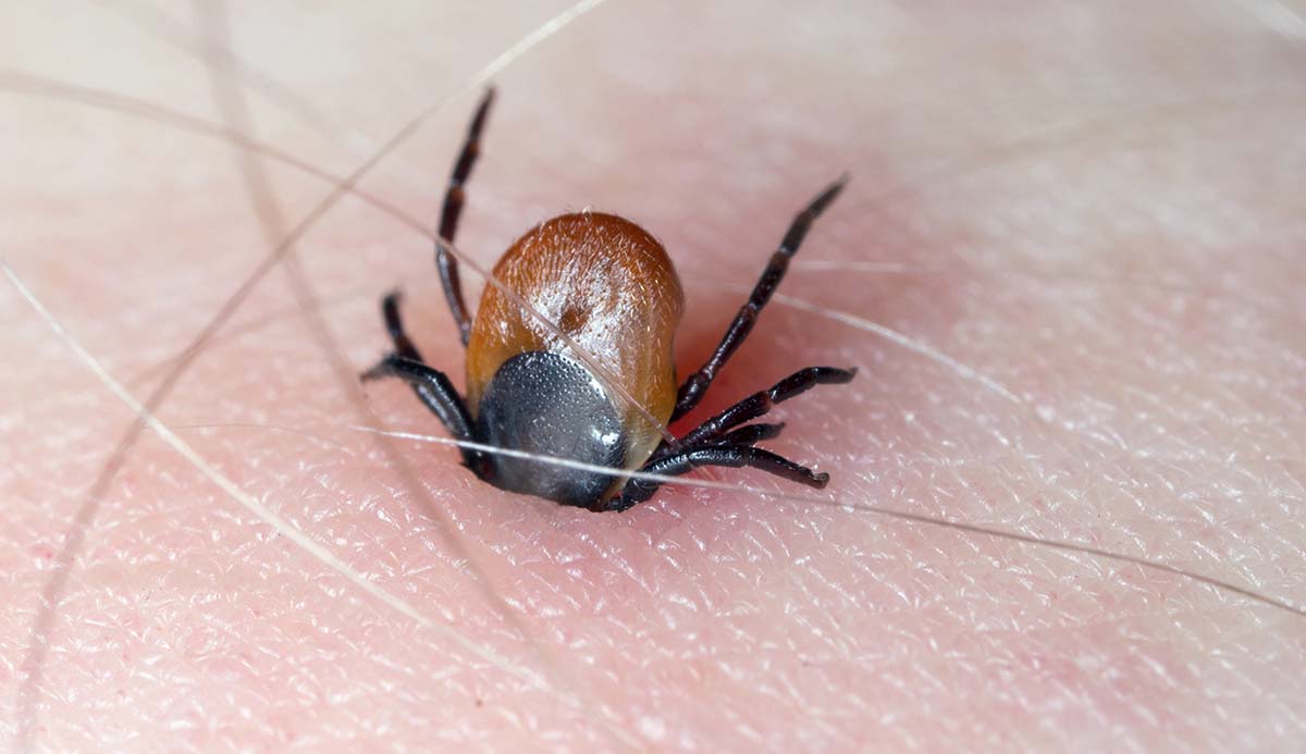 A reddish-brown and black tick with its mouthparts stuck into a person's skin.