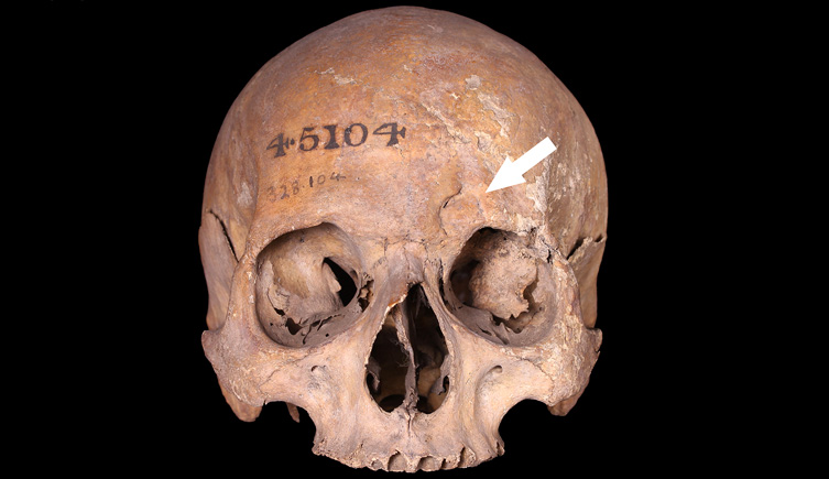 Cranium of an adult with blunt and sharp force trauma