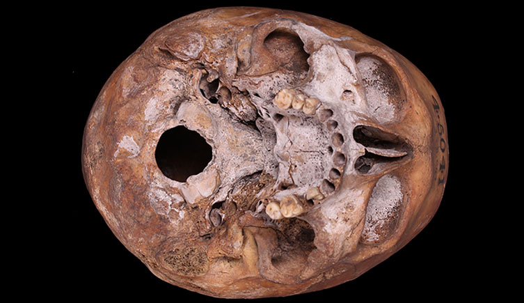 Cranium of an adult male with cribra orbitalia