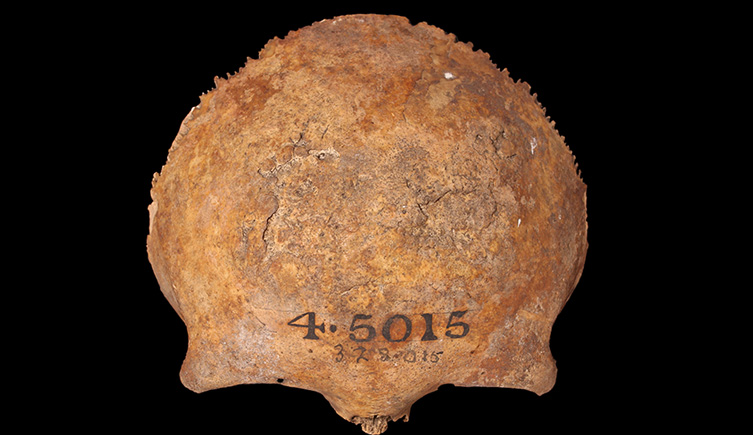 The frontal bone of an adult with syphilis