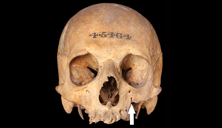 Cranium of an adult male with arrow pointing to malunion of facial fracture
