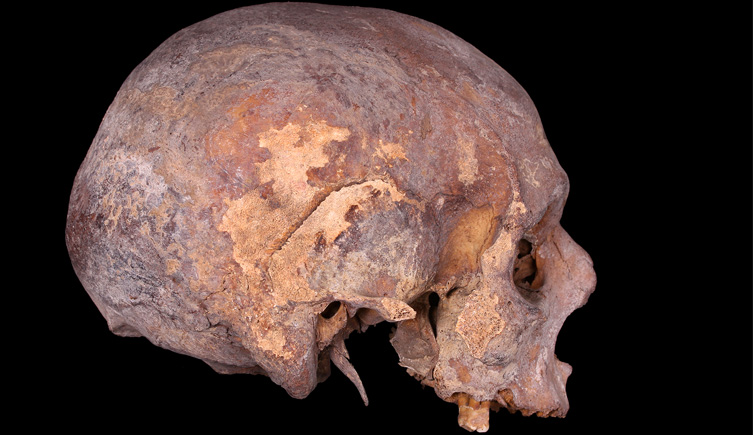 Cranium of adult female with cribra orbitalia