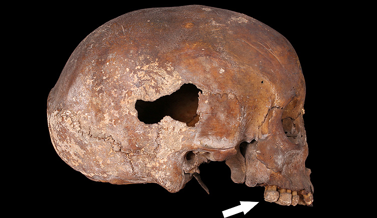 Individual with linear enamel hypoplasia of the teeth