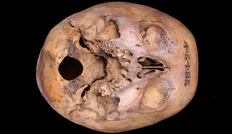 Cranium of a child with cribra orbitalia