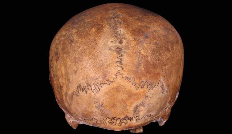 Cranium with tripartite inca bone