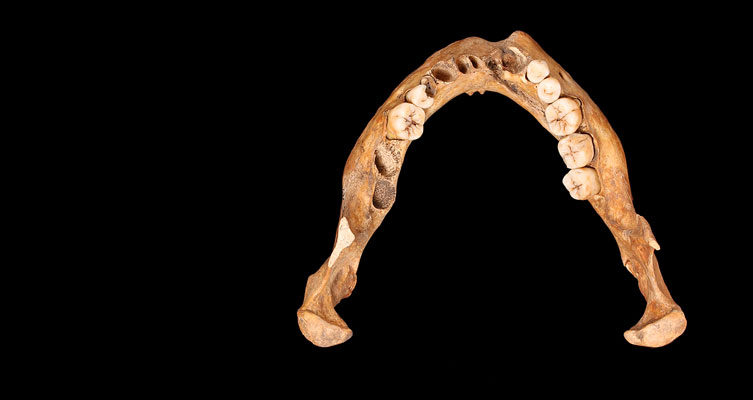 Mandible of an adult with fractures