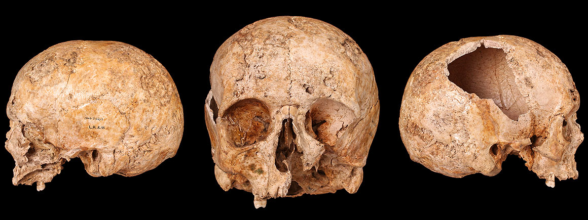 Skull of a male with tertiary syphilis from Ludgate Hill cemetery