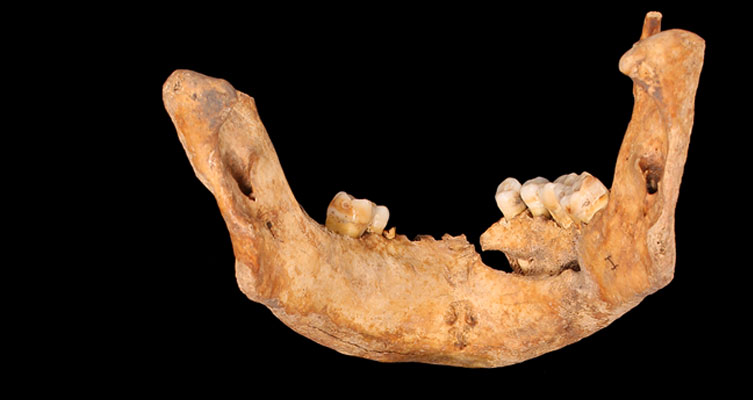 Mandible of an adult with facial trauma