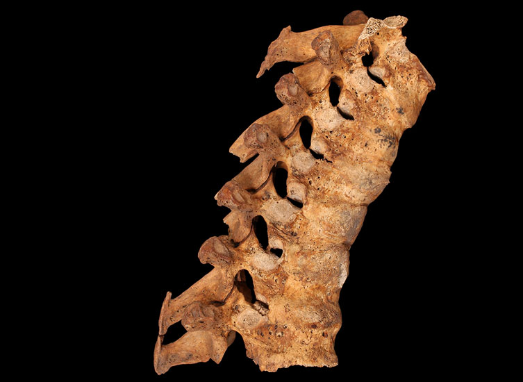 Thoracic vertebrae exhibiting diffuse idiopathic skeletal hyperostosis (DISH)