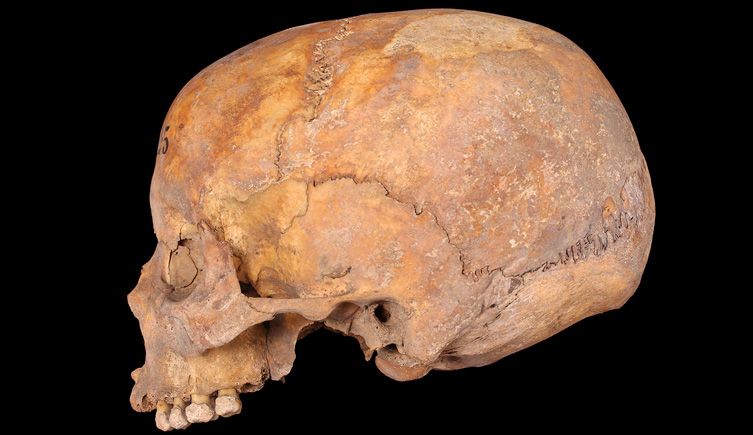 Cranium with dental calculus on the teeth