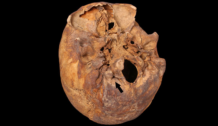 Cranium with large bony protuberance