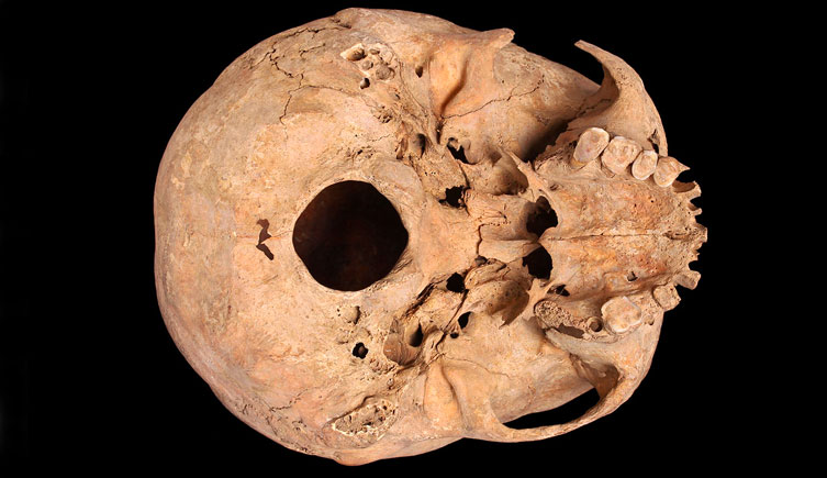 Basal view of cranium found at Bermondsey Abbey showing extensive tooth wear