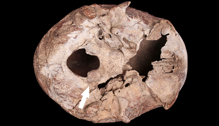 View of the base of the skull of individual excavated at Old Ford, Bow showing congenital changes